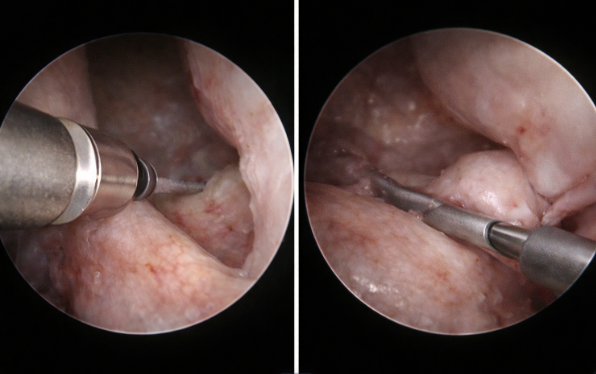 Arthroscopic surgical view